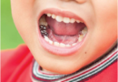 Is Dental Crowning Better For Your Baby Tooth? What Is Its Importance?