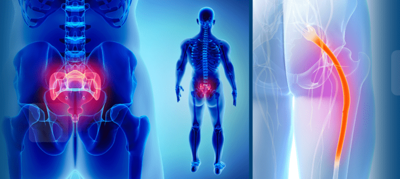 What Activities Should You Avoid With Sciatica?