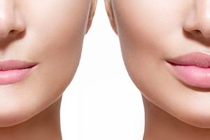 Lip Surgery Can Help You To Look More Attractive And Confident