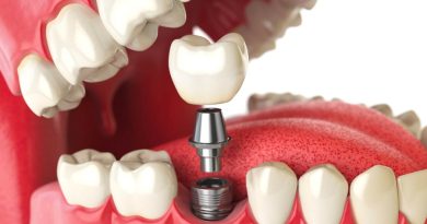 What Are Different Types of Dental Implants