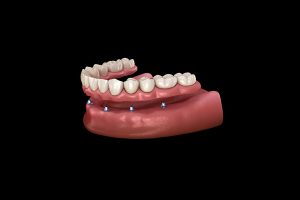 Fixed Artificial Teeth Based on Implants
