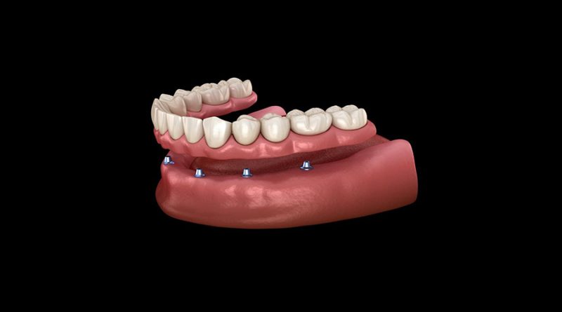 Fixed Artificial Teeth Based on Implants