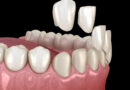 How Is the Treatment of Coated Tooth Infection