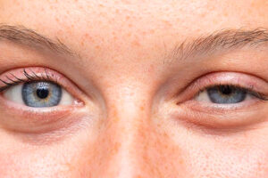Different Sorts Of Treatments For Ptosis
