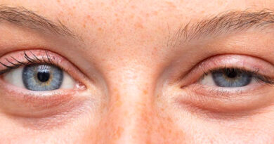 Different Sorts Of Treatments For Ptosis