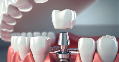 Dental Implants Explained