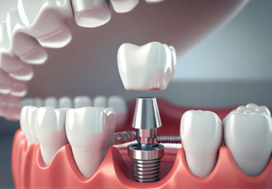 Dental Implants Explained