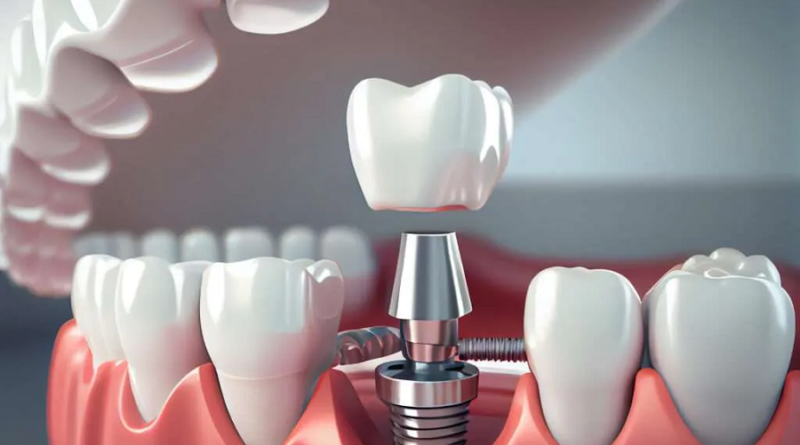 Dental Implants Explained