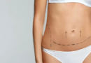 Liposuction in Qatar: A Comprehensive Guide to the Procedure and What to Expect