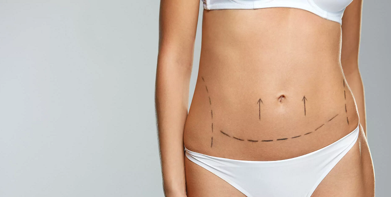 Liposuction in Qatar: A Comprehensive Guide to the Procedure and What to Expect