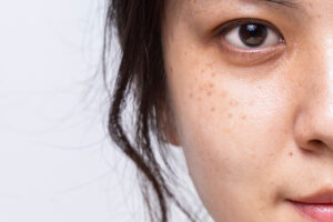 Laser Treatment for Dark Spots How It Works and Why Its Effective