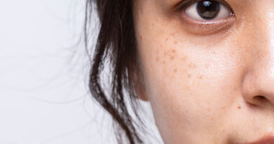 Laser Treatment for Dark Spots How It Works and Why Its Effective