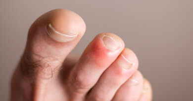 The Treatment of Chilblains