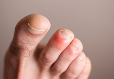 The Treatment of Chilblains