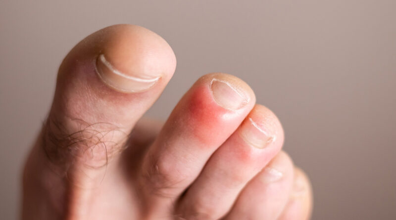 The Treatment of Chilblains